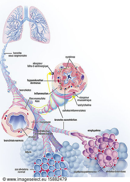 Chronic obstructive pulmonary disease COPD and its treatments. Top left ...