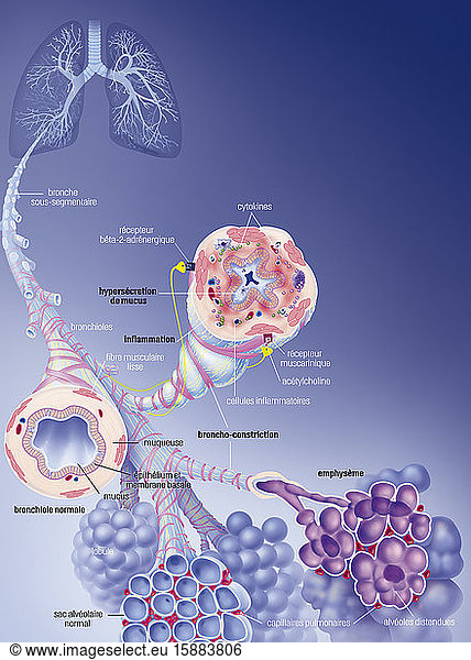 Chronic obstructive pulmonary disease COPD and its treatments. Top left ...