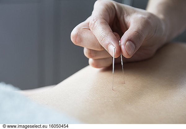 Close up acupuncturist applying acupuncture needles to woman?s back