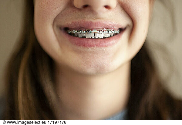 Close up of braces on teeth of a teen girl against blank wall