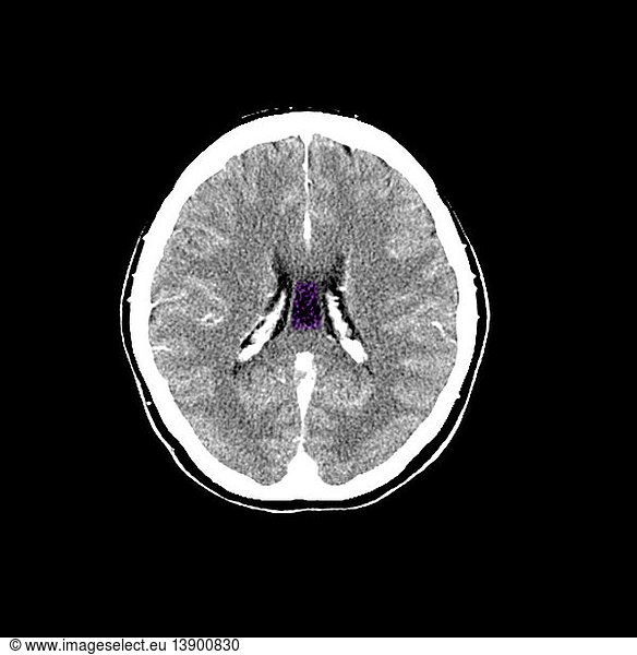 Color Enhanced CT of Cavum Septum Pellucidum Color Enhanced CT of Cavum ...