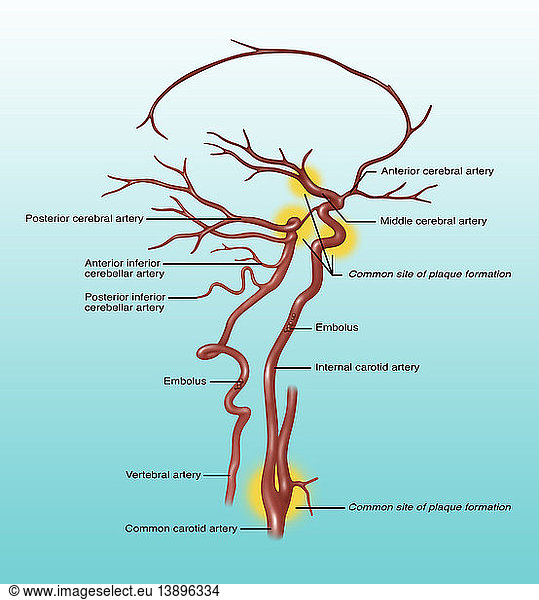 Common Blocked Arteries Common Blocked Arteries, Illustration,annotated ...