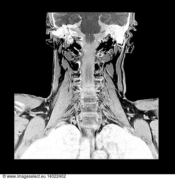 Coronal MRI of Brachial Plexus Coronal MRI of Brachial Plexus,brachial ...