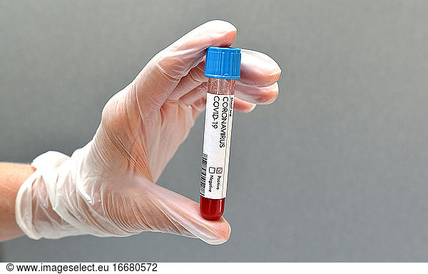 Coronavirus test blood sample positive result on white background.