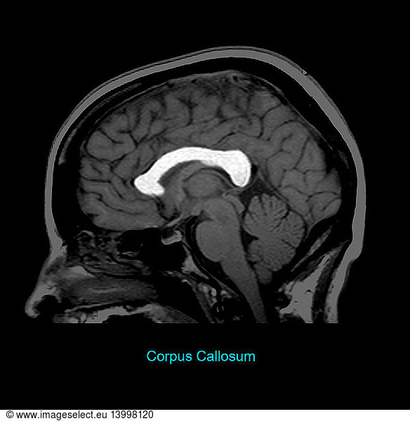 Corpus Callosum Corpus Callosum, Sagittal MRI,brain anatomy,brain,brain ...