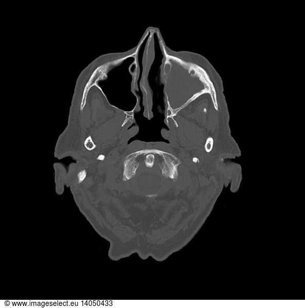 Ct Of Chronic Maxillary Sinusitis Ct Of Chronic Maxillary Sinusitis