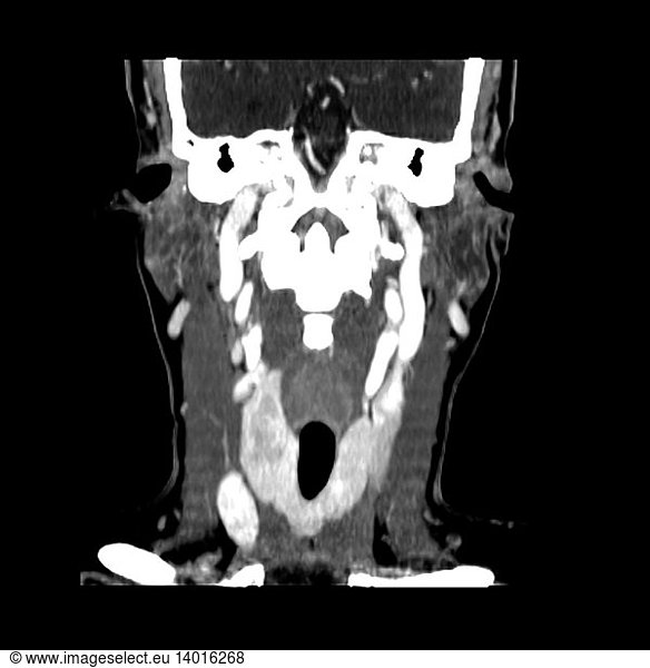 CT of neck showing thyroid nodule CT of neck showing thyroid nodule ...