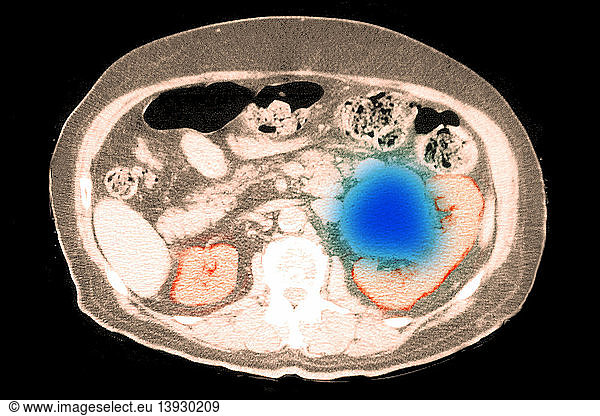 Ct Scan Of A Kidney Cyst Ct Scan Of A Kidney Cystcomputed Axial