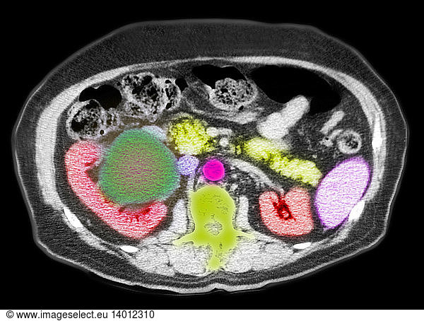 Ct Scan Of A Kidney Cyst Ct Scan Of A Kidney Cystbowelcomputed Axial