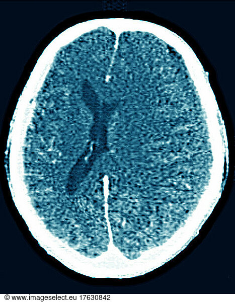 CT scan of brain edema (abnormal accumulation of fluid in brain tissue ...