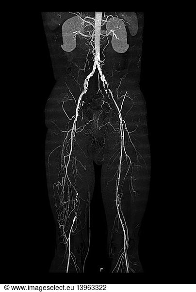 Cta Runoff And Abdominal Pelvic Cta Cta Runoff And Abdominal Pelvic Cta D Cta Angiogram Of