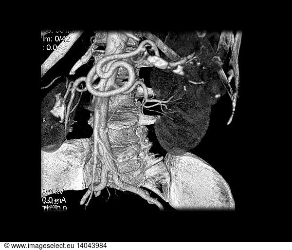 CTA Of Abdominal Aorta And Branches CTA Of Abdominal Aorta And Branches