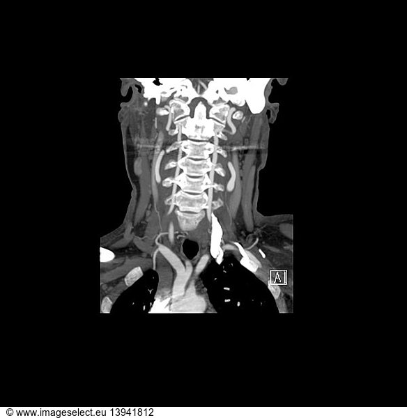 CTA of Neck - Vertebral Arteries CTA of Neck - Vertebral Arteries