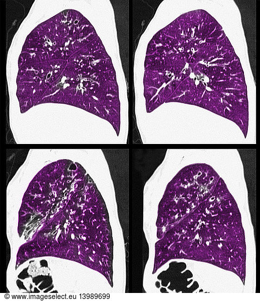 Cystic Fibrosis of the Lungs Cystic Fibrosis of the Lungs, CT Scan ...