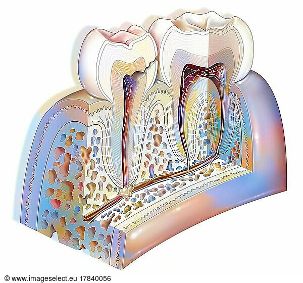 Dental plaque: third stage tooth decay (damage to the dental pulp).