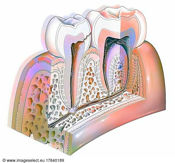 Dental plaque: third stage tooth decay (damage to the dental pulp).
