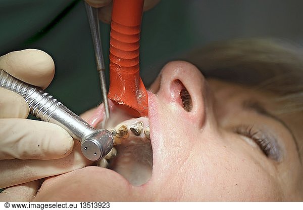 Dentist grinding teeth stumps