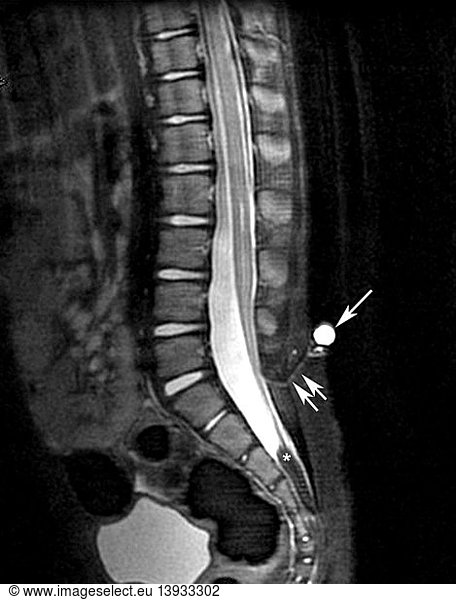 Dermal Sinus and Intradural Lipoma Dermal Sinus and Intradural Lipoma ...