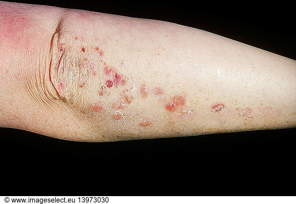 Dermatitis Herpetiformis Dermatitis Herpetiformis,abnormal,abnormality ...