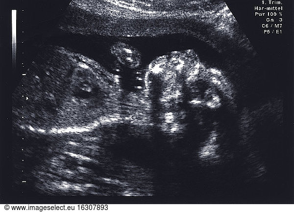 Deutschland  Ultraschallbild eines fünf Monate alten weiblichen Fötus
