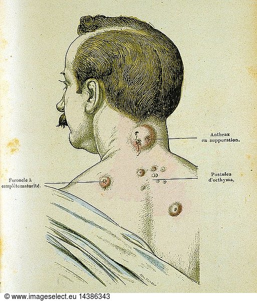 Development of pustules in a man suffering from Anthrax  a disease which could be c ontracted from contact with infected farm animals. The anthrax bacillus was the first bacterium to be identified (1841) and in 1881 Louis Pasteur successfully tested a vaccine on sheep. Engraving c1895.