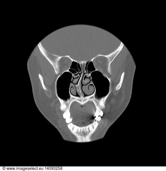 Deviated Septum Deviated Septum,abnormal ct of sinuses,abnormal nose