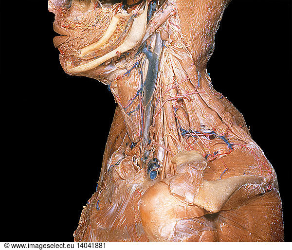 Dissected Neck