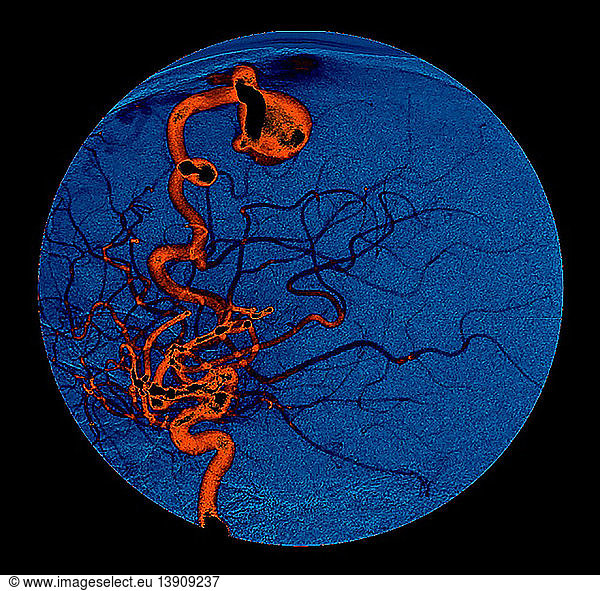 Enhanced MRI of Arterial Venous Fistulas 7c Enhanced MRI of Arterial ...