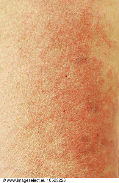 Erythema. An erythema is a skin lesion characterised by a congestive ...