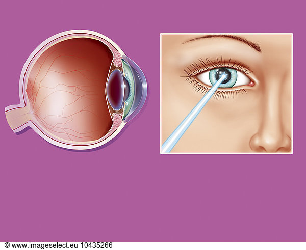 EYE SURGERY EYE SURGERY, DRAWING,anatomy Anatomical normal No pathology ...