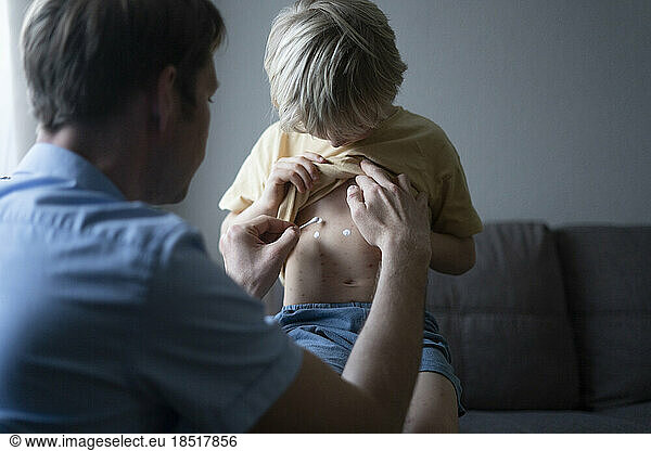 Father applying ointment on son's chickenpox at home
