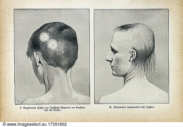 Fehlen vom Farbstoff am Kopfhaar und bedeutender Haarausfall nach Typhus  Der praktische Hausarzt  Ein Weg zur Gesundheit  1901  Breslau