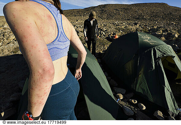 Female team member of a climate change expedition in Greenland shows the extent of bites received from swarms of mosquitos while hiking from the base camp to Grottedalen to explore the valley of caves; Greenland