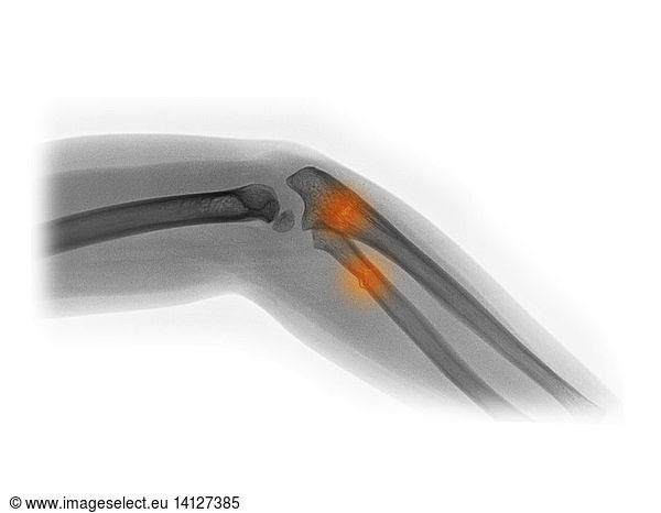 fractured-radius-and-ulna-in-a-4-year-old-fractured-radius-and-ulna-in