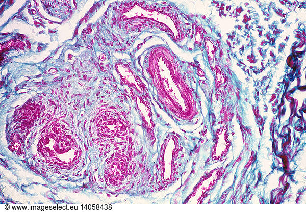 Glomus Body showing Arteriovenous Fistula Glomus Body showing ...