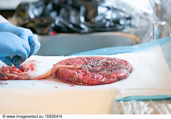 Gloved hands with placenta on white pad attached to umiblical cord.