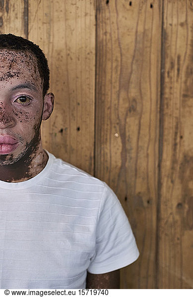 Halbporträt eines jungen Mannes mit Vitiligo vor einer Holzwand