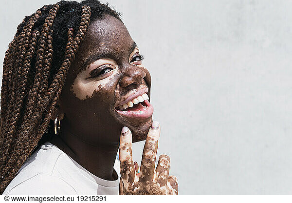 Happy young woman with vitiligo and depigmentation in front of white wall