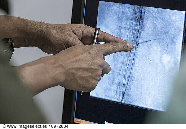 heart catheter when replacing an aortic valve
