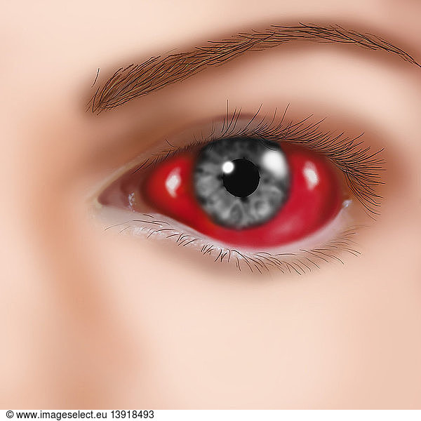 hemorrhage-in-the-eye-hemorrhage-in-the-eye-conjunctival-hemorrhage