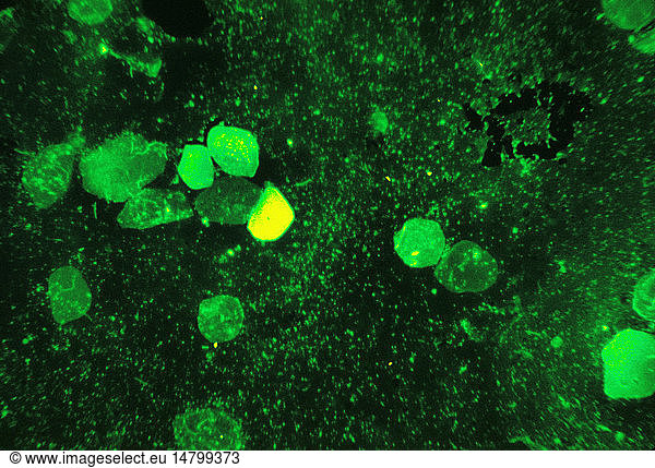 Here We See Mycobacterium Tuberculosis In A Sputum Smear Is Stained Using Fluorescent Acid Fast 5487