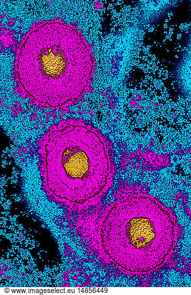 Herpes Simplex Virus (hsv-2). It Causes Gential Herpes. The Hsv 