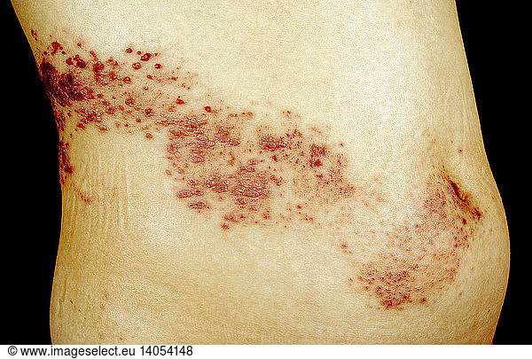 herpes-zoster-rash-on-abdomen-herpes-zoster-rash-on-abdomen-abdomen