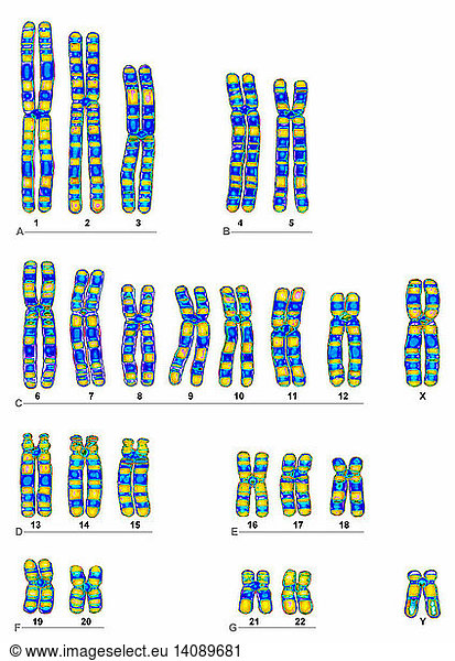 Human Karyotype Human Karyotype,autosome,denver classification,denver ...