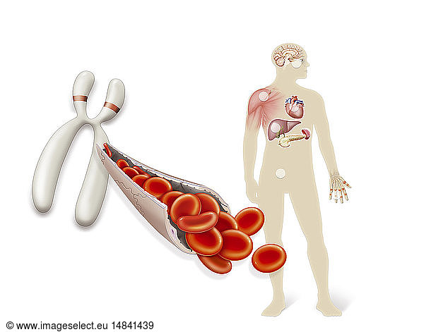 Illustration der Hämochromatose  einer vererbbaren genetischen Störung  die das HFE-Gen auf Chromosom 6 betrifft und ein Ungleichgewicht des eisenhaltigen Transferrins im Blut verursacht. Dieses Ungleichgewicht führt zu einer übermäßigen Eisenaufnahme und zu einer Überlastung der Eisenspeicher bestimmter Organe.