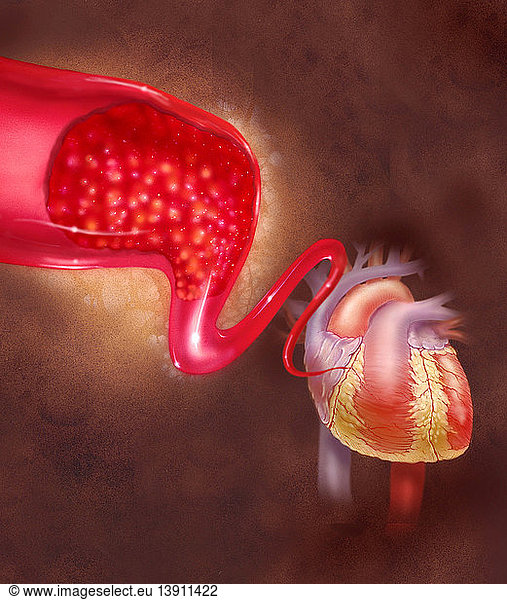 Illustration of a blood clot Illustration of a blood clot,work,blood ...