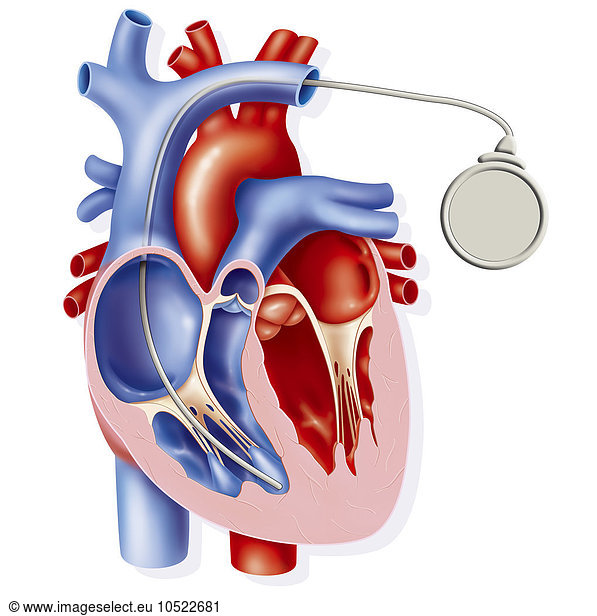 Illustration of a pacemaker consisting of a box positioned under the ...