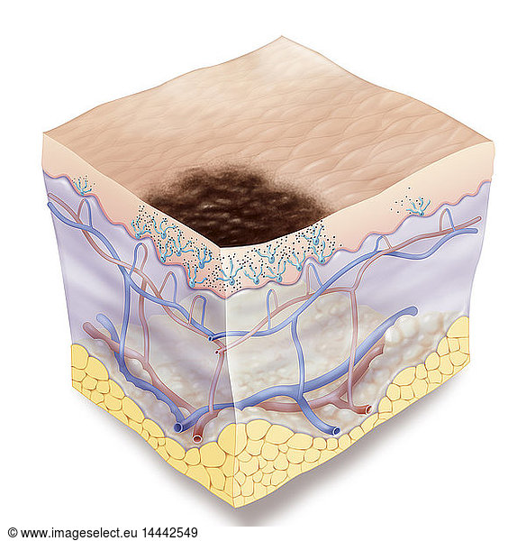 Illustration of a stage 0 melanoma. The melanoma has irregular serrated ...