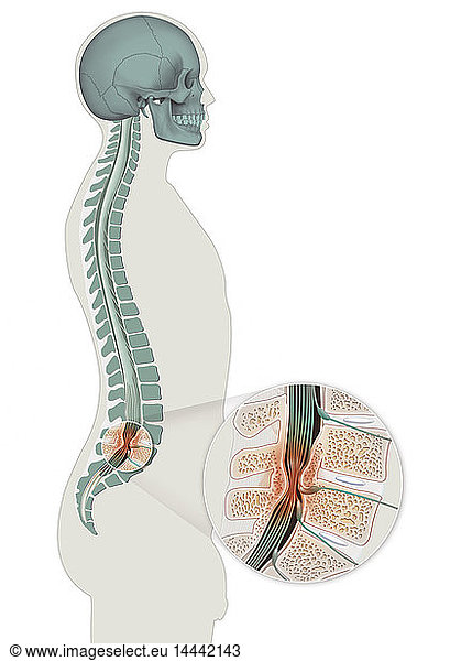 Illustration of spinal stenosis in L4 and L5. Spinal stenosis is a ...