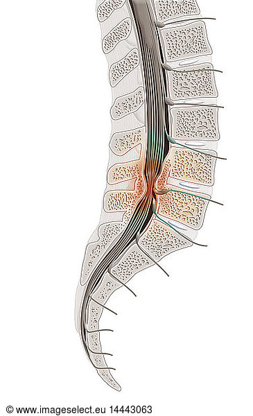 Illustration of spinal stenosis in L4 and L5. Spinal stenosis is a ...